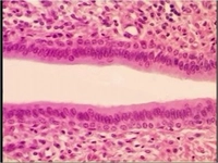 İdrarda Yassı Epitel Tedavisi