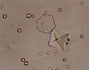 İdrar Eritrosit Belirtileri ve Tedavisi
